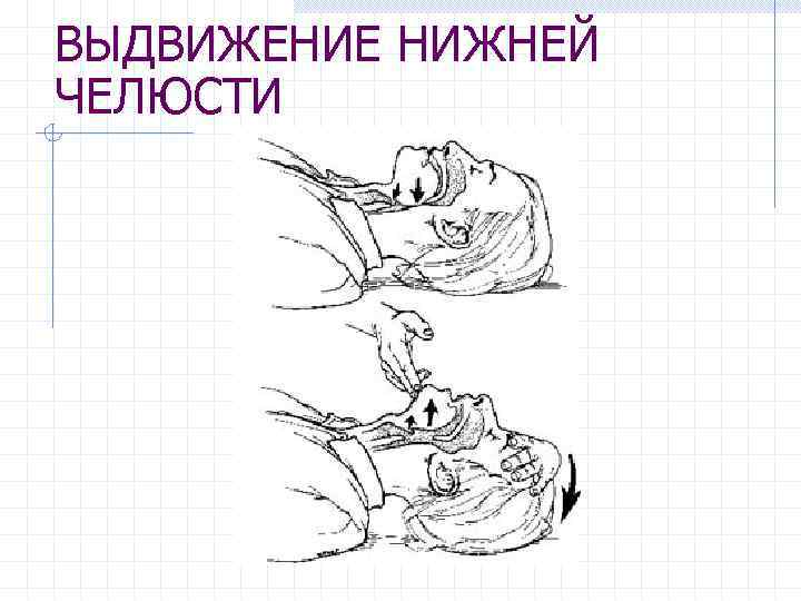 ВЫДВИЖЕНИЕ НИЖНЕЙ ЧЕЛЮСТИ 