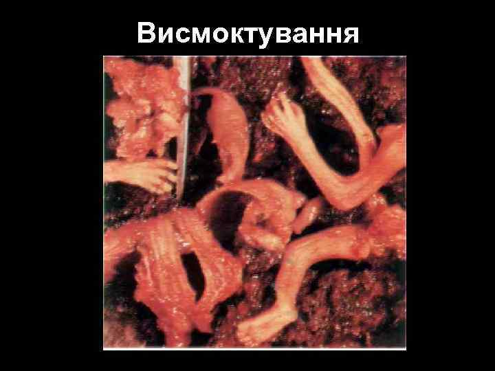 Висмоктування 