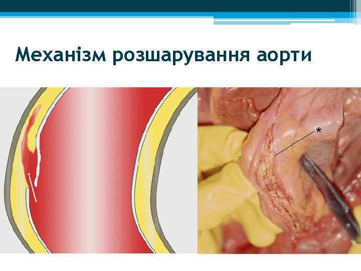 Механізм розшарування аорти 