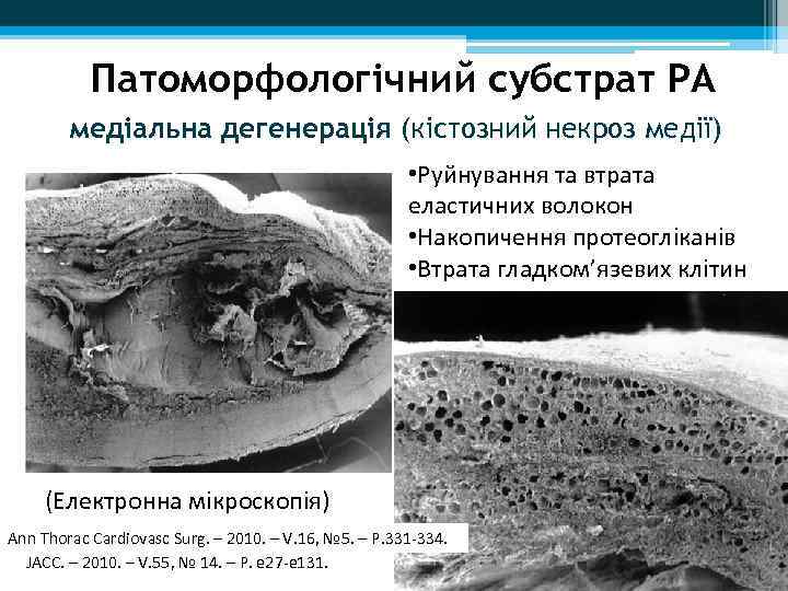 Патоморфологічний субстрат РА медіальна дегенерація (кістозний некроз медії) • Руйнування та втрата еластичних волокон