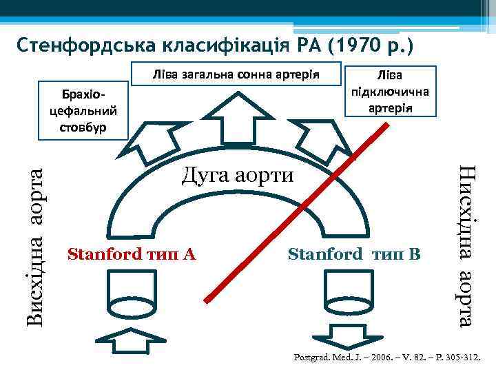 Стенфордська класифікація РА (1970 р. ) Ліва загальна сонна артерія Дуга аорти Stanford тип