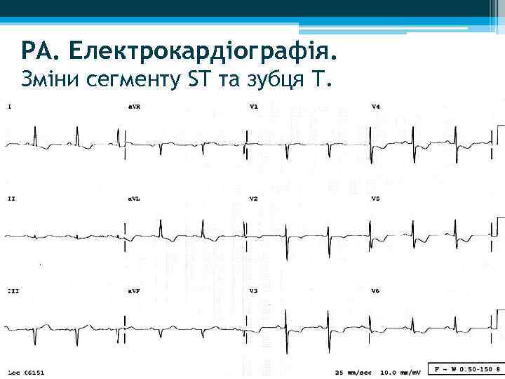 РА. Електрокардіографія. Зміни сегменту ST та зубця Т. 