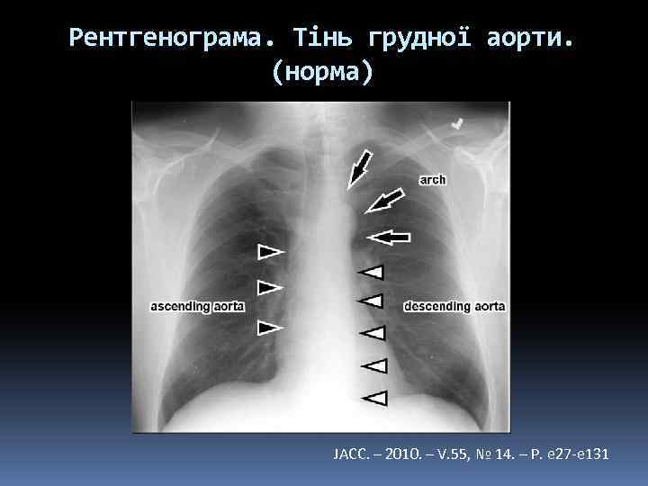 Рентгенограма. Тінь грудної аорти. (норма) JACC. – 2010. – V. 55, № 14. –