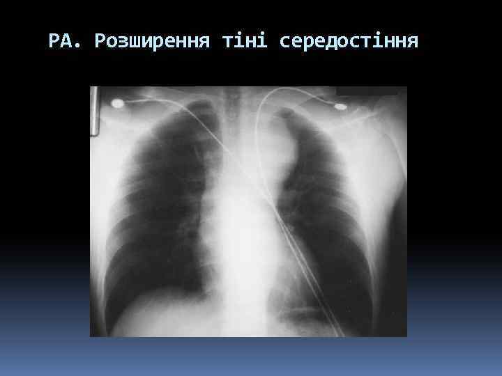 РА. Розширення тіні середостіння 