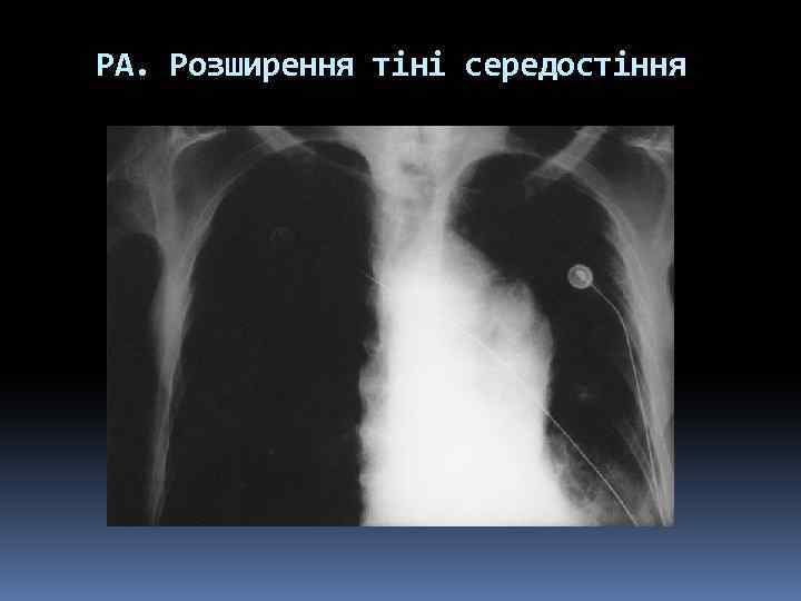 РА. Розширення тіні середостіння 