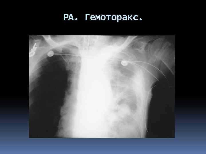 РА. Гемоторакс. 