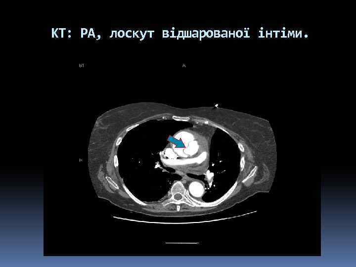 КТ: РА, лоскут відшарованої інтіми. 