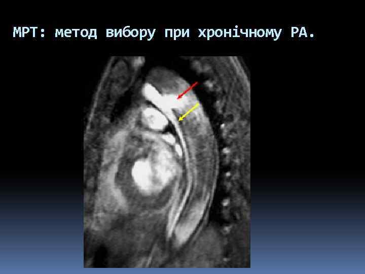 МРТ: метод вибору при хронічному РА. 