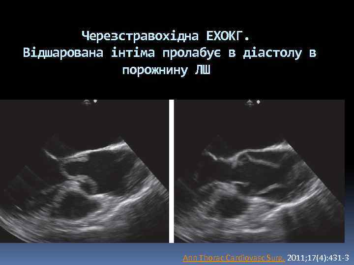 Черезстравохідна ЕХОКГ. Відшарована інтіма пролабує в діастолу в порожнину ЛШ Ann Thorac Cardiovasc Surg.