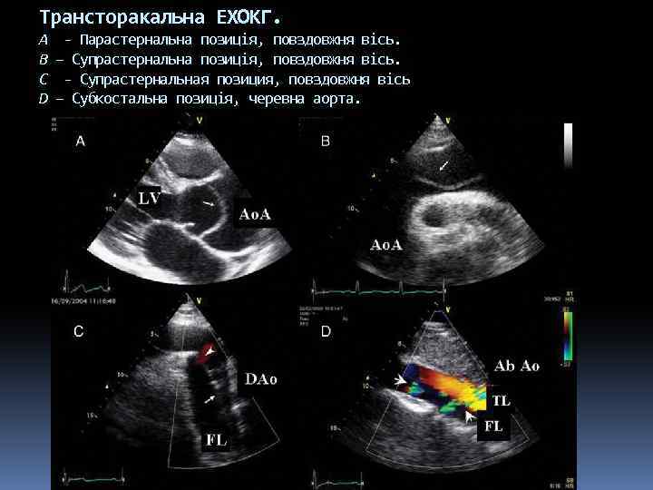 Трансторакальна ЕХОКГ. A B C D - Парастернальна позиція, повздовжня вісь. – Супрастернальна позиція,