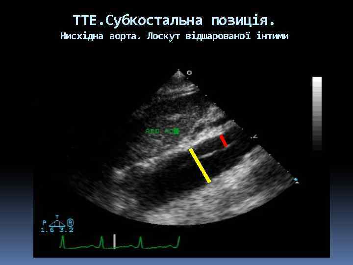 ТТЕ. Субкостальна позиція. Нисхідна аорта. Лоскут відшарованої інтими 