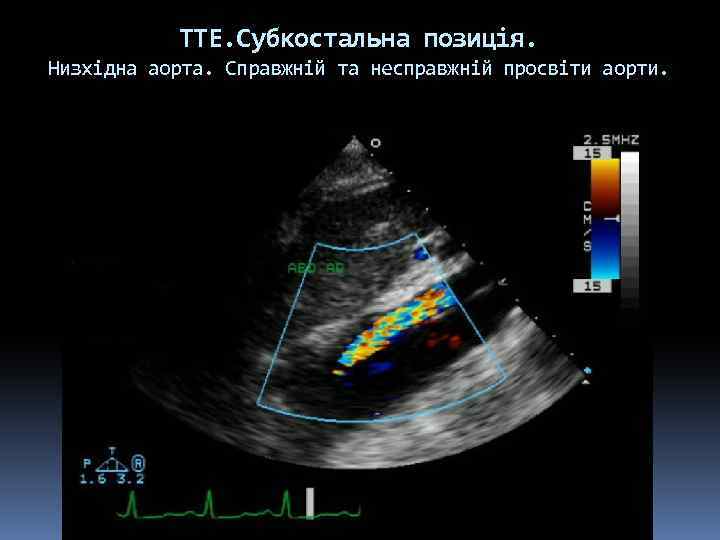 ТТЕ. Субкостальна позиція. Низхідна аорта. Справжній та несправжній просвіти аорти. 