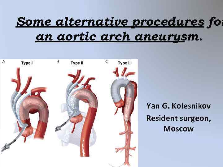 Some alternative procedures for an aortic arch aneurysm. Yan G. Kolesnikov Resident surgeon, Moscow