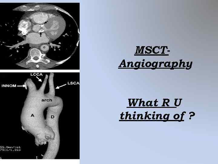 MSCTAngiography What R U thinking of ? 