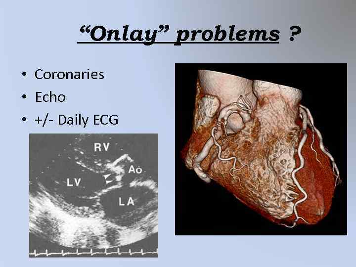 “Onlay” problems ? • Coronaries • Echo • +/- Daily ECG 