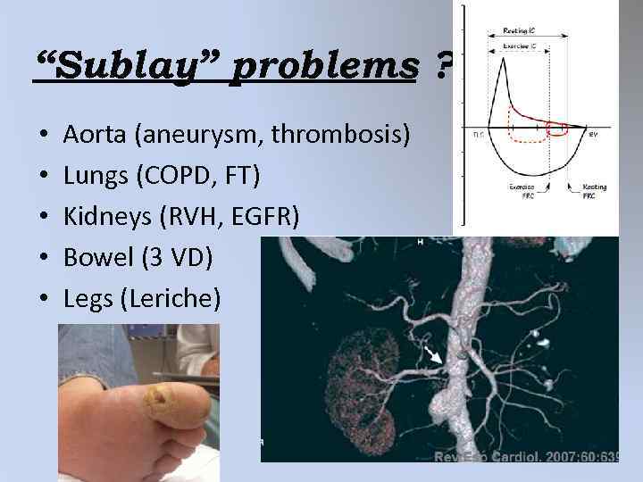 “Sublay” problems ? • • • Aorta (aneurysm, thrombosis) Lungs (COPD, FT) Kidneys (RVH,