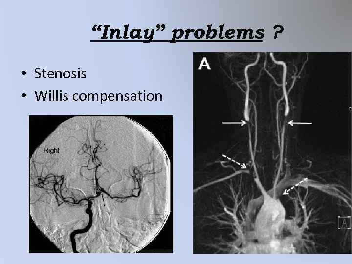 “Inlay” problems ? • Stenosis • Willis compensation 