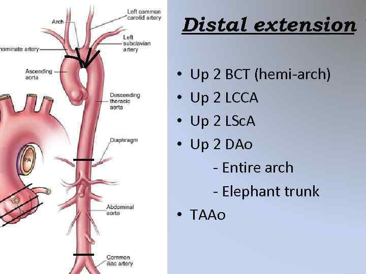 Distal extension ? Up 2 BCT (hemi-arch) Up 2 LCCA Up 2 LSc. A