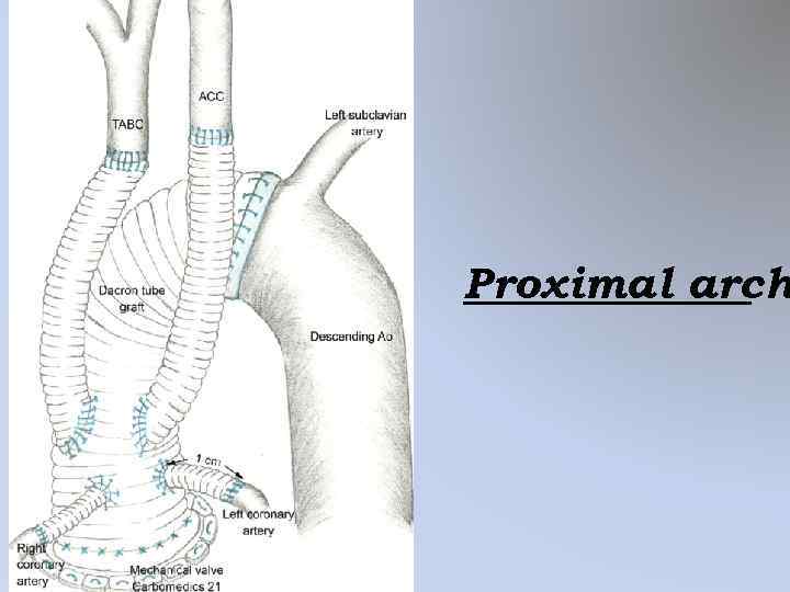 Proximal arch 