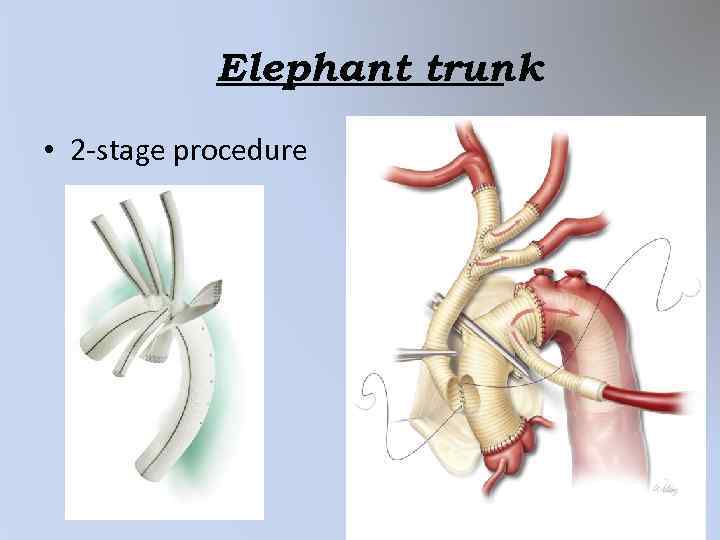 Elephant trunk • 2 -stage procedure 
