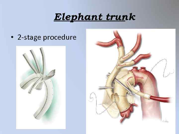 Some alternative procedures for an aortic arch aneurysm