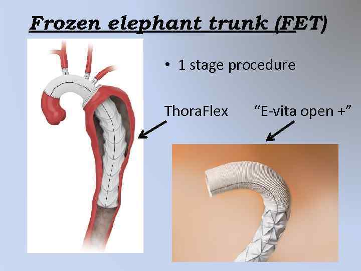 Frozen elephant trunk (FET) • 1 stage procedure Thora. Flex “E-vita open +” 