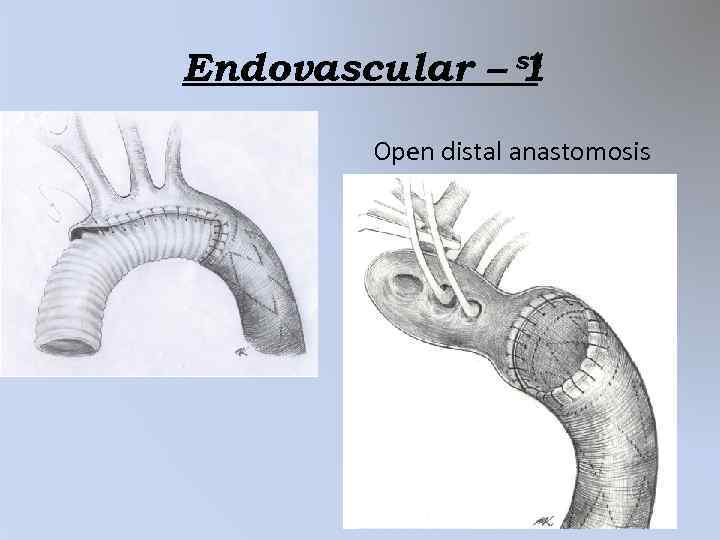 Endovascular – st 1 Open distal anastomosis 