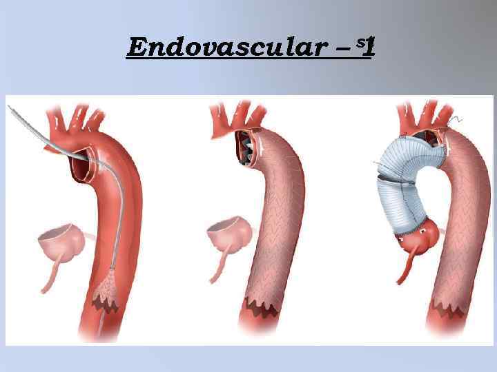 Endovascular – st 1 