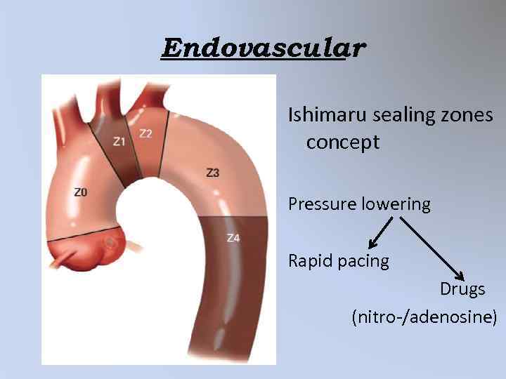 Endovascular Ishimaru sealing zones concept Pressure lowering Rapid pacing Drugs (nitro-/adenosine) 