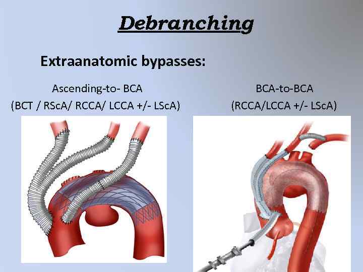 Debranching Extraanatomic bypasses: Ascending-to- BCA (BCT / RSc. A/ RCCA/ LCCA +/- LSc. A)