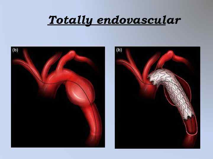 Totally endovascular 