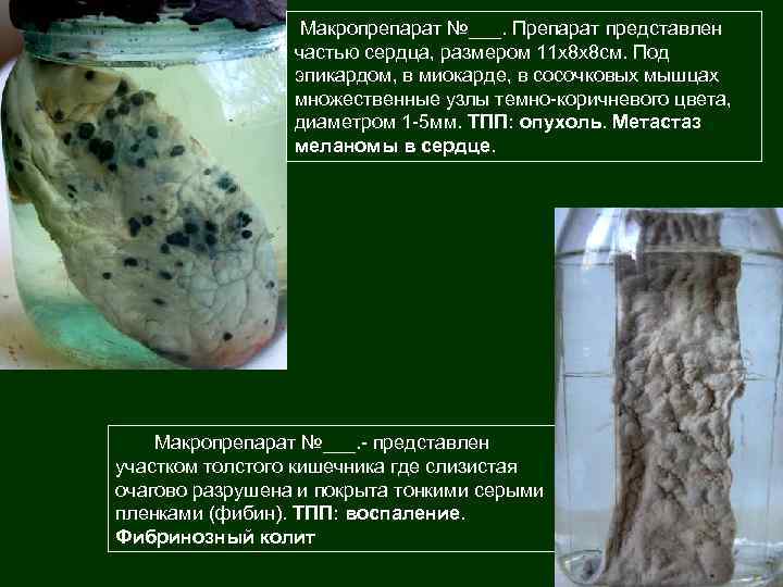 Макропрепарат №___. Препарат представлен частью сердца, размером 11 х8 х8 см. Под эпикардом, в