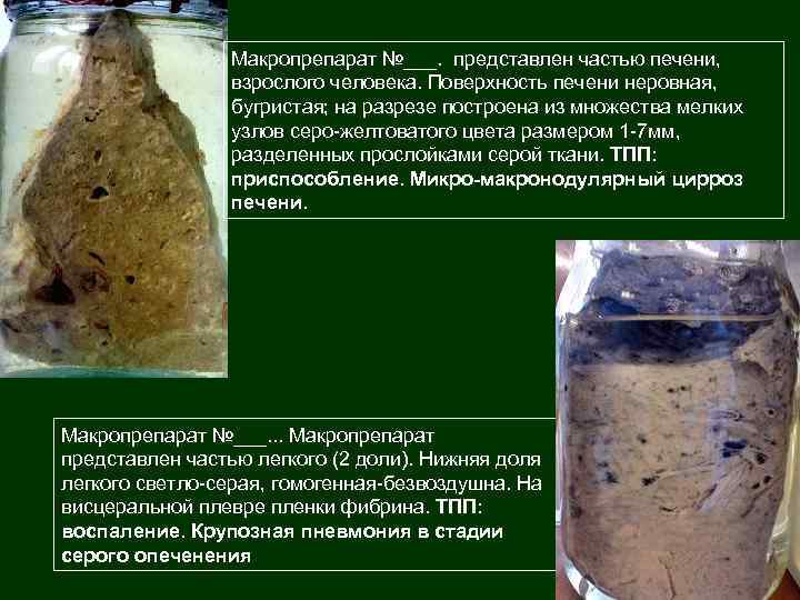 Макропрепарат №___. представлен частью печени, взрослого человека. Поверхность печени неровная, бугристая; на разрезе построена