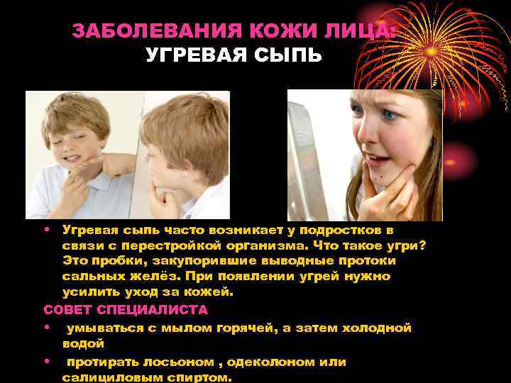 ЗАБОЛЕВАНИЯ КОЖИ ЛИЦА: УГРЕВАЯ СЫПЬ • Угревая сыпь часто возникает у подростков в связи
