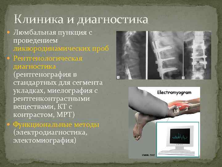 Клиника и диагностика Люмбальная пункция с проведением ликвородинамических проб Рентгенологическая диагностика (рентгенография в стандартных