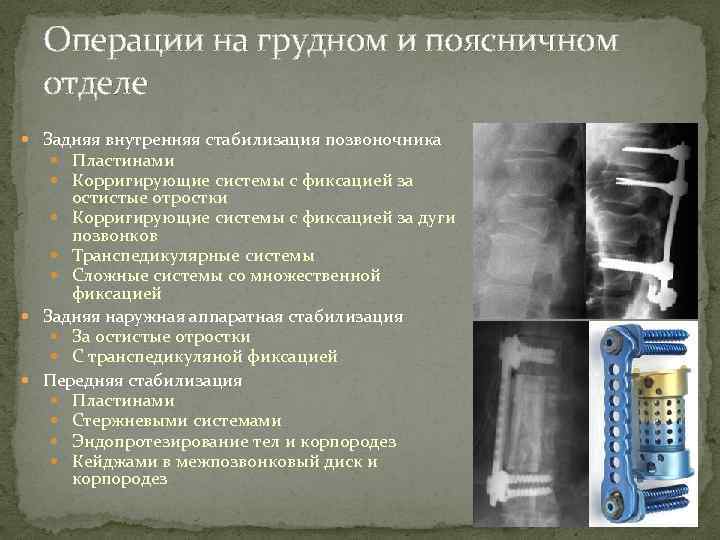 Операции на грудном и поясничном отделе Задняя внутренняя стабилизация позвоночника Пластинами Корригирующие системы с