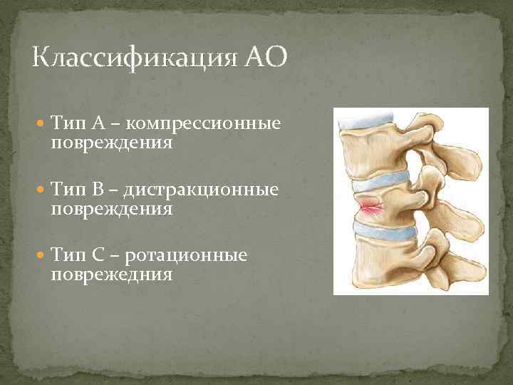 Классификация АО Тип А – компрессионные повреждения Тип В – дистракционные повреждения Тип С