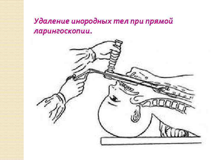 Удаление инородных тел при прямой ларингоскопии. 