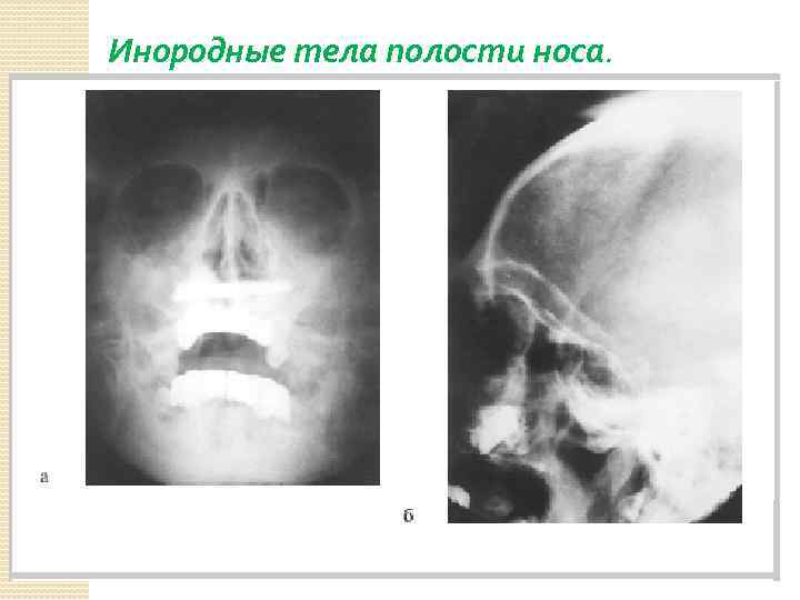 Инородные тела полости носа. 
