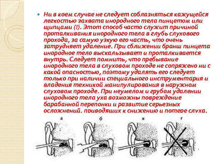  Ни в коем случае не следует соблазняться кажущейся легкостью захвата инородного тела пинцетом