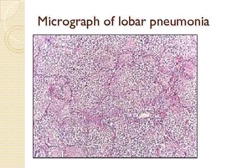 Micrograph of lobar pneumonia 