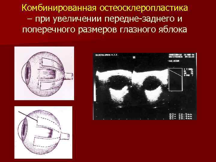 Комбинированная остеосклеропластика – при увеличении передне-заднего и поперечного размеров глазного яблока 