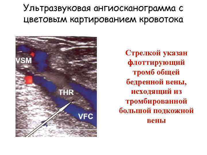 Ультразвуковая ангиосканограмма с цветовым картированием кровотока Стрелкой указан флоттирующий тромб общей бедренной вены, исходящий