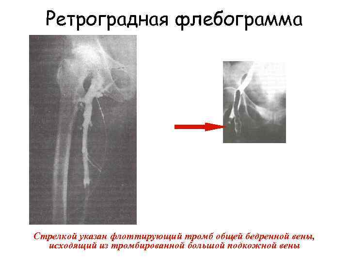 Артериальный тромбоз нижних конечностей фото