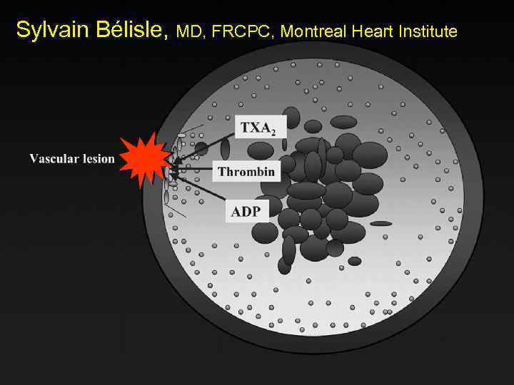 Sylvain Bélisle, MD, FRCPC, Montreal Heart Institute 