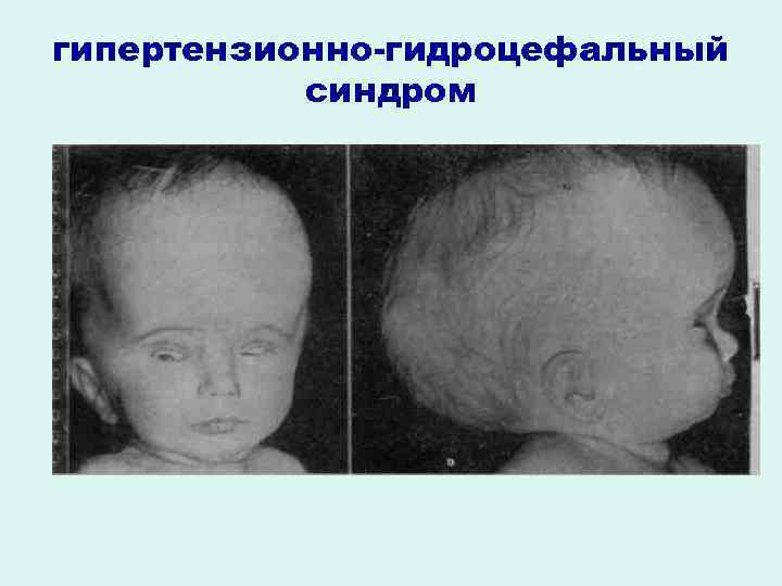гипертензионно-гидроцефальный синдром 