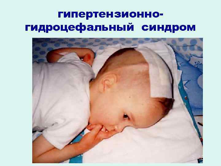 гипертензионногидроцефальный синдром 