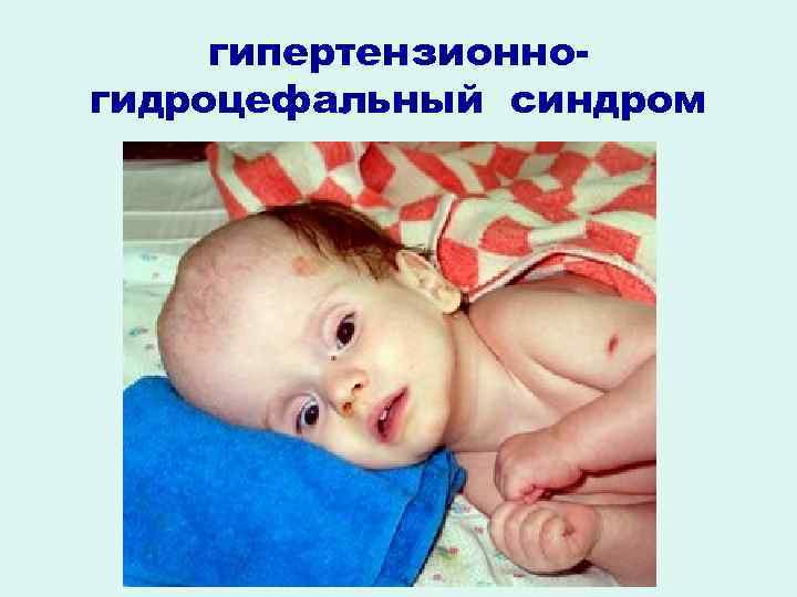 гипертензионногидроцефальный синдром 