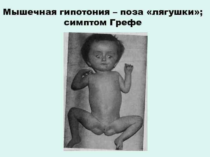 Мышечная гипотония – поза «лягушки» ; симптом Грефе 