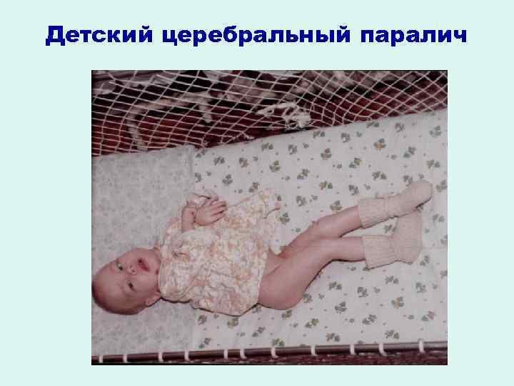 Детский церебральный паралич 